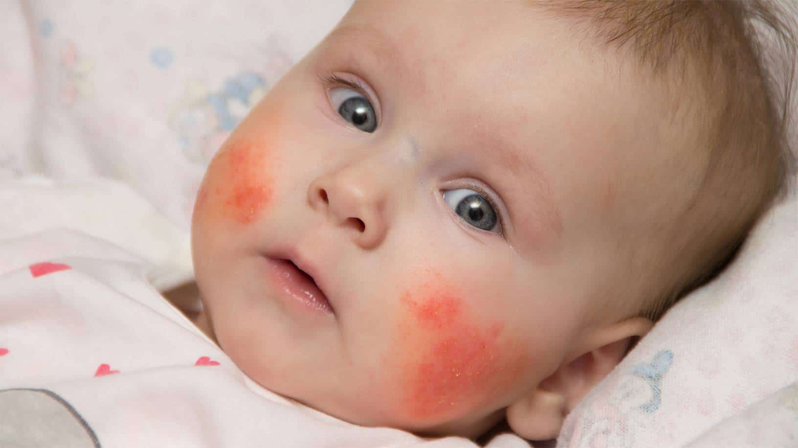 Babies food allergy symptoms and tips