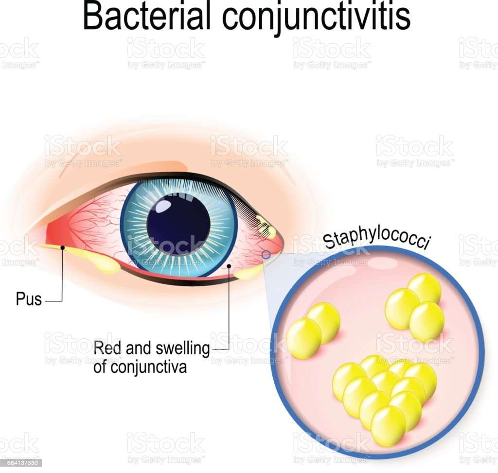 Bacterial Conjunctivitis Stock Vector Art &  More Images of ...