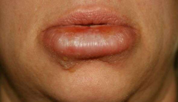 Can A Cold Sore Cause Swollen Lip