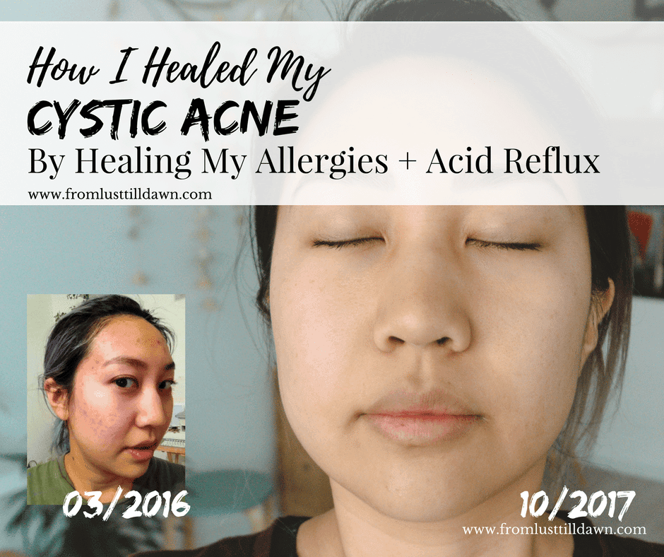 Can Allergies Cause Cystic Acne? [Spoiler Alert: Food Allergies and ...