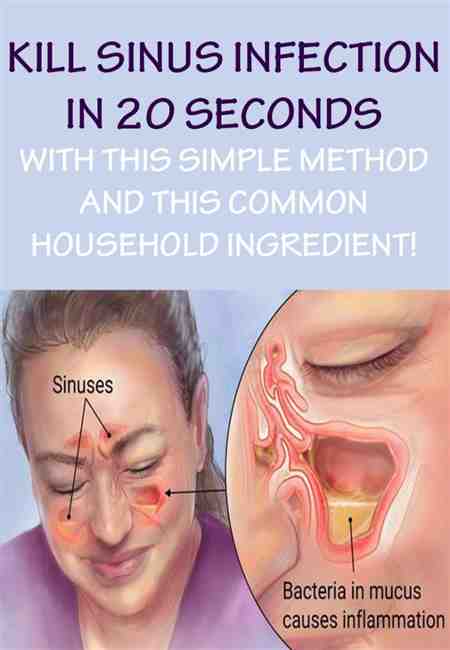 Can Allergies Cause Sinus Pressure And Headaches