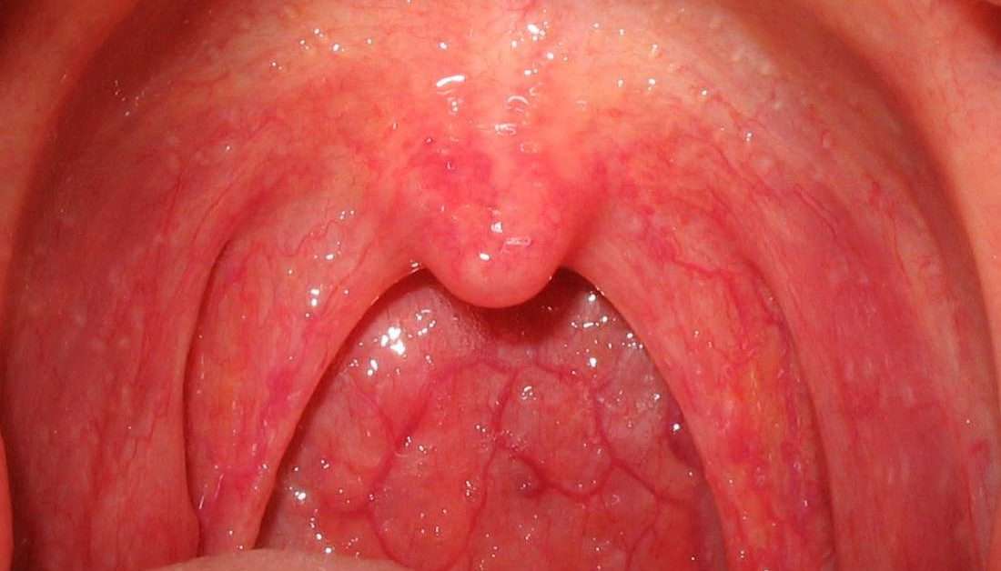Can Sinus Drainage Make My Throat Sore