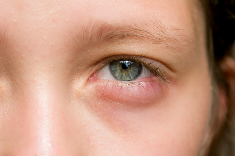 Can Sun Poisoning Cause Swollen Eyes? Symptoms and Treatment Inside