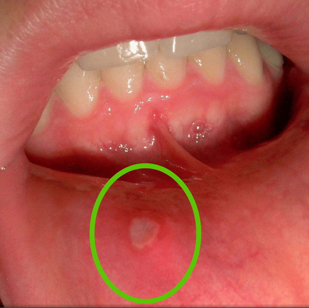 Canker sore in mouth