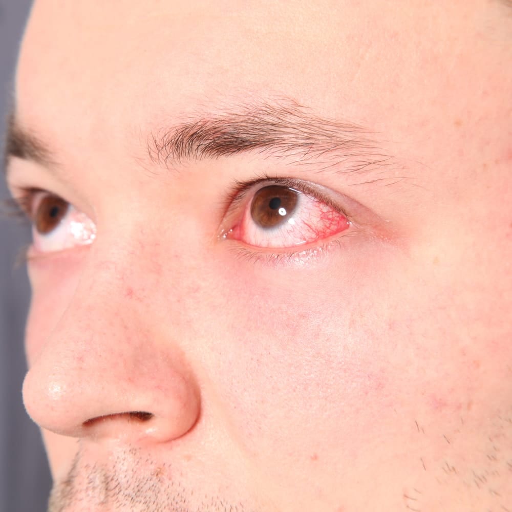 Causes and Treatments of Eye Allergies