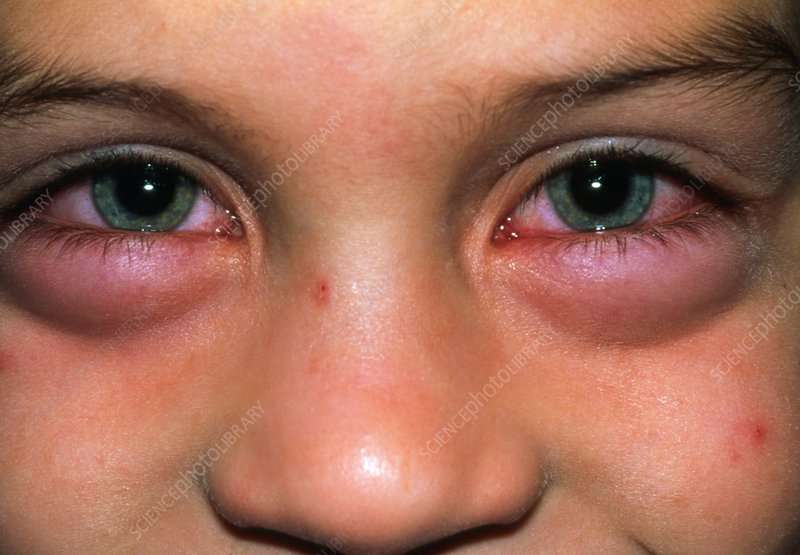 Child with swollen eyes from an allergic reaction