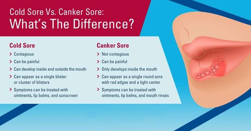 Cold Sores vs Canker Sores