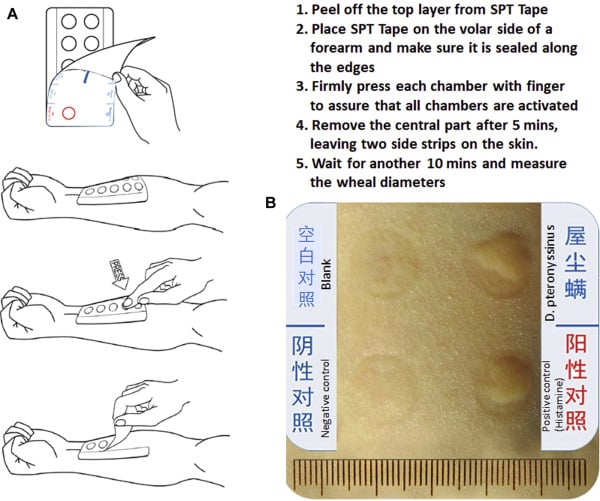 Comparison of a new Skin Prick Test Tape with the conventional skin ...