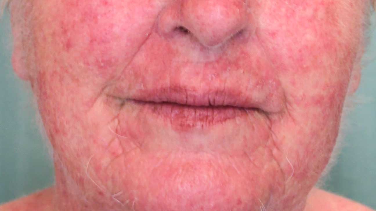 Contact dermatitis on face how long does it last ...