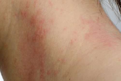Contact Dermatitis, Skin Rash from Allergens triggered