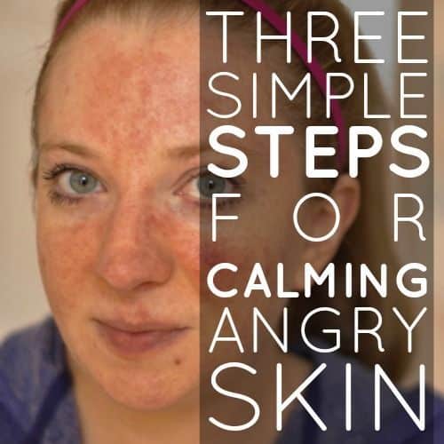 Daily Mom Â» 3 Simple Steps For Calming Angry Skin