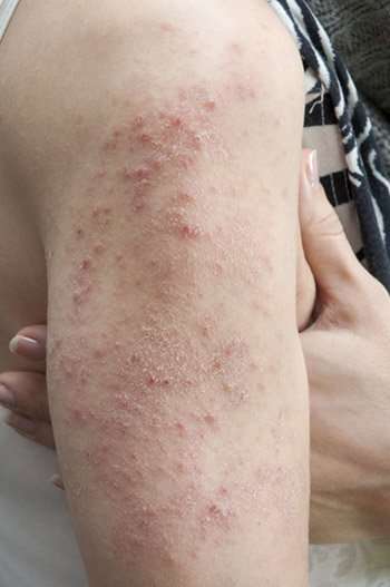 Dermatologists explain when to seek treatment for a rash ...