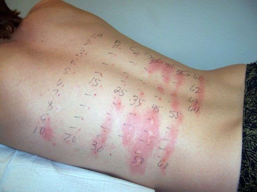 designedbymoto: How Expensive Are Allergy Tests