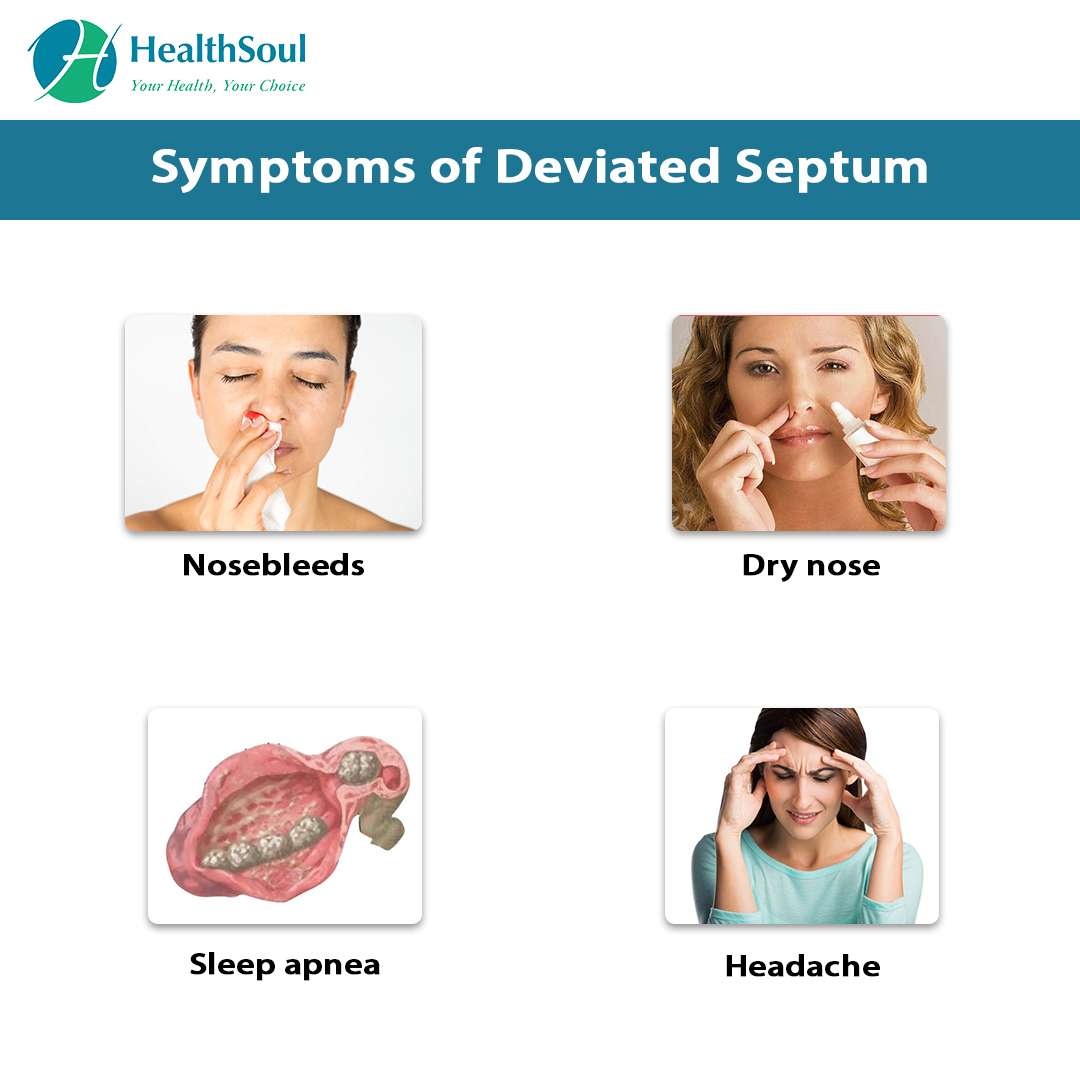 Deviated Nasal Septum: Causes and Treatment â Healthsoul