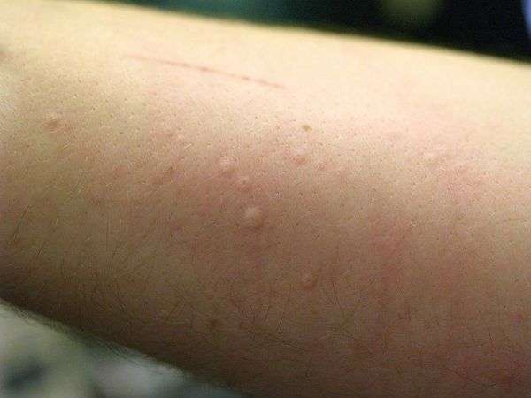 Do Your Mosquito Bites Sting And Swell? You Could Have ...
