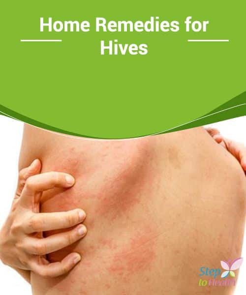 Effective Home Remedies For Hives