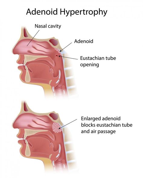 Enlarged Adenoid: A common condition in children