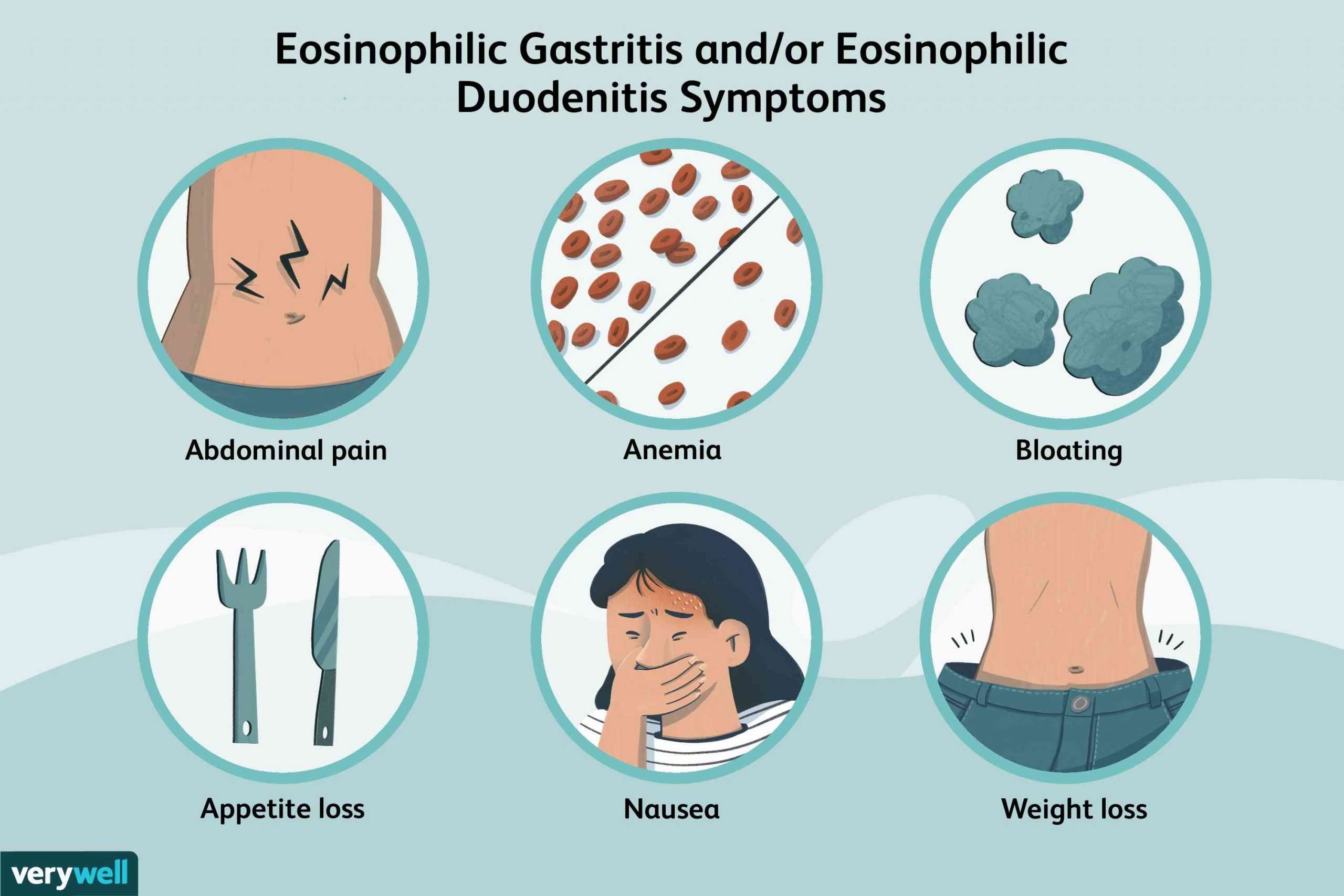 Eosinophilic Gastritis and/or Eosinophilic Duodenitis ...