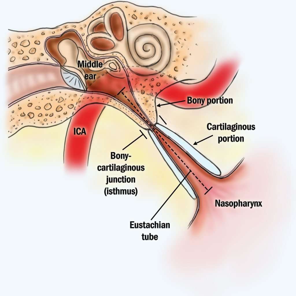 Eustachian Tube Dysfunction