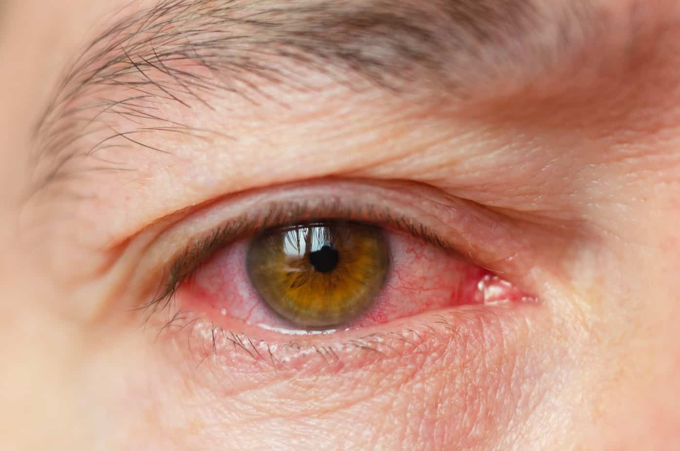 Eye Allergies: Causes and Treatment Options