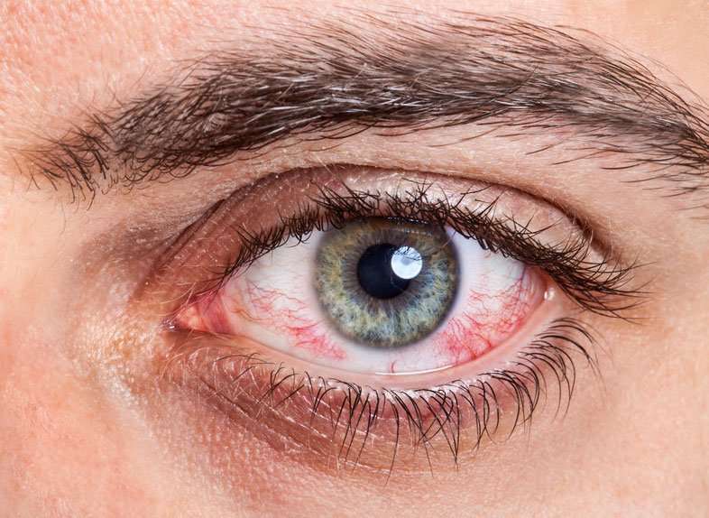 Eye Allergy (Allergic Conjunctivitis)