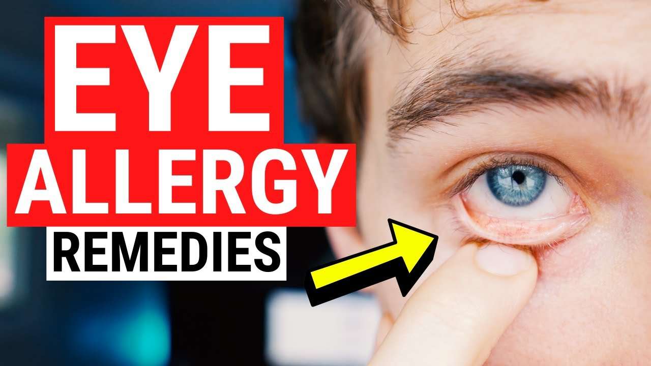 Eye Allergy Remedies