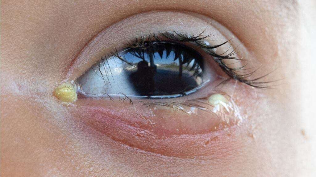 Eye Discharge: Causes, Associated Conditions, and Treatments