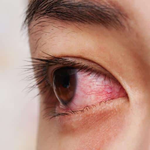 Eye Disease Treatment  Eye Braces Clinic