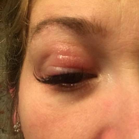 Eye Irritation Allergies