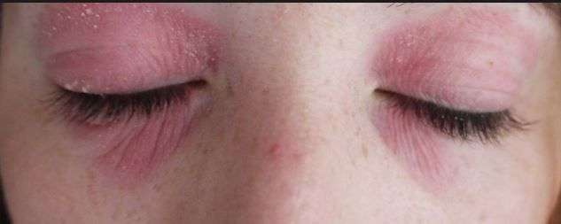 Eyelid dermatitis Picture, Red, Dry, Itchy Eyelids ...