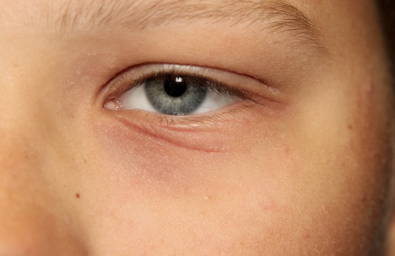 Eyelid Dermatitis: What to Do When Itch Strikes ...