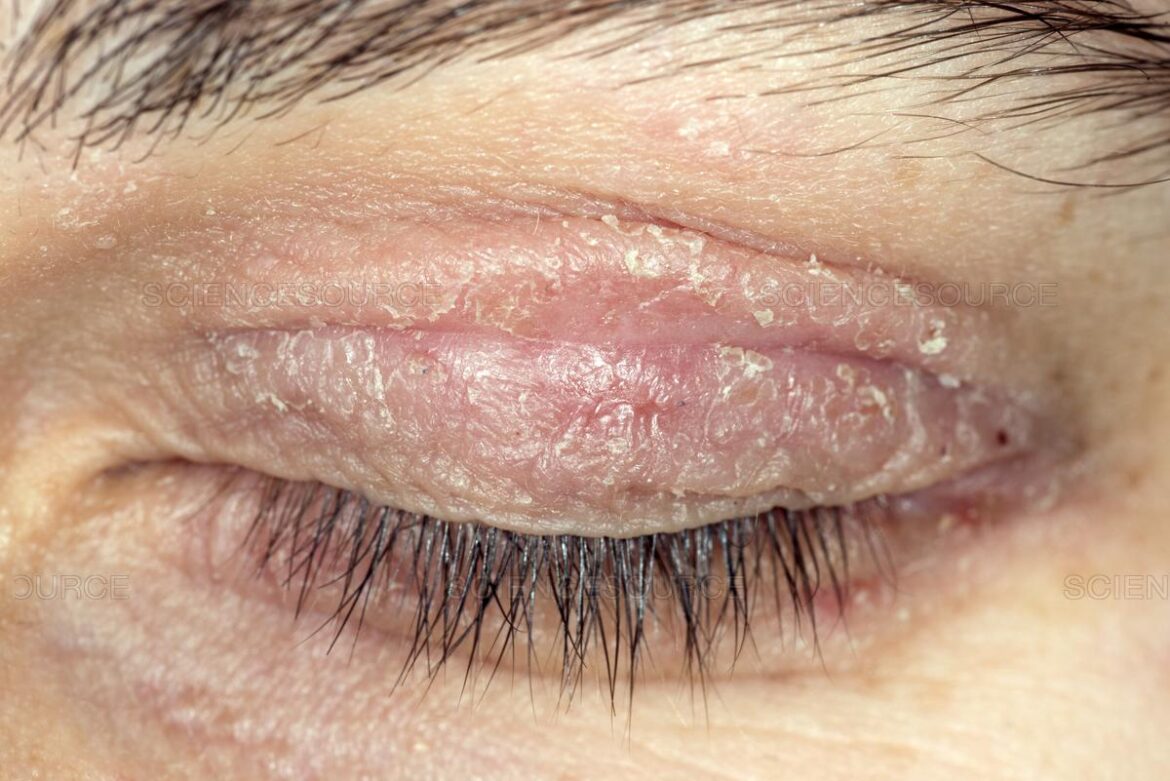 Eyelid Redness Causes, Symptoms, Inflamed, Dry Itchy Swollen Red ...