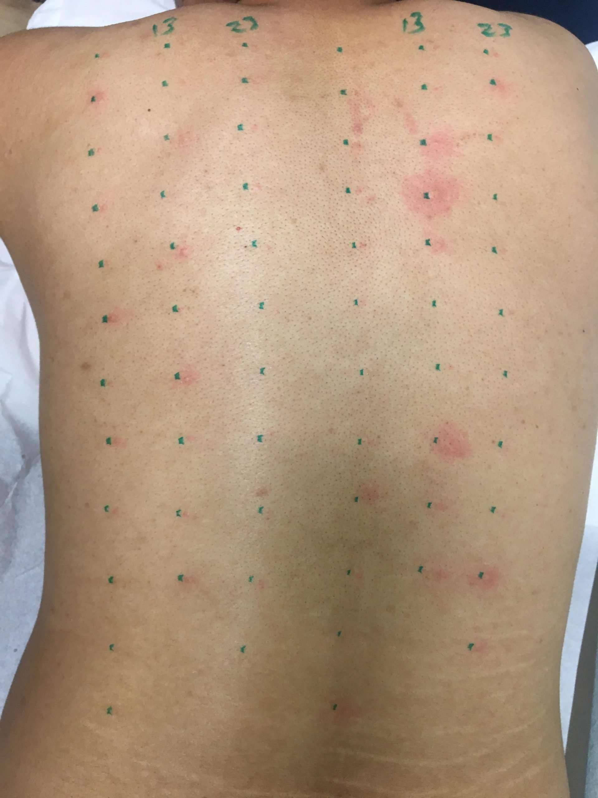 First time getting an allergy test. Is this reaction worth ...