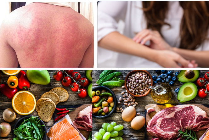 Food Allergy: Causes, Symptoms, Diagnosis, Treatment ...