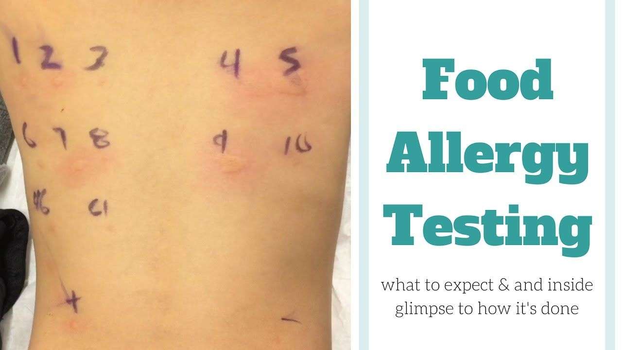 Food Allergy Skin Testing (With images)
