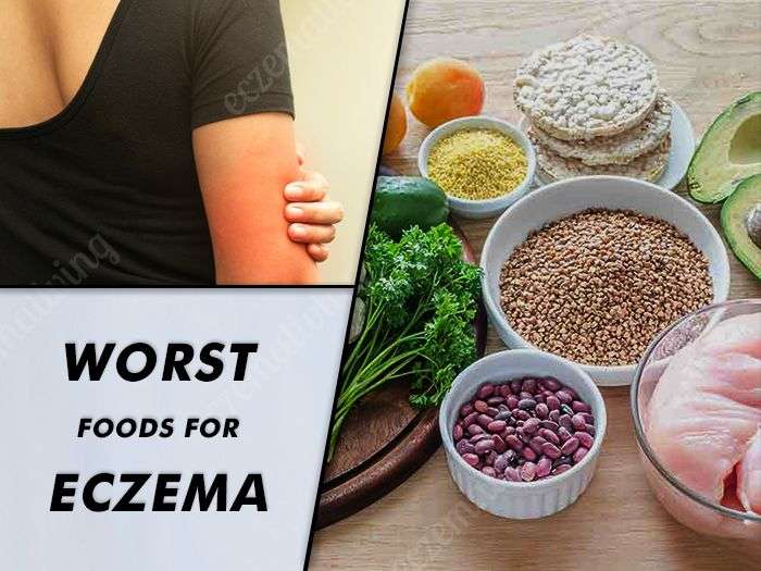 Food Triggers Eczema â Foods to Avoid To Get Rid Of Eczema ...