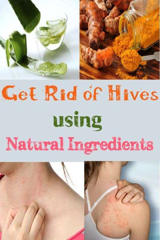 Get Rid of Hives using Natural Ingredients