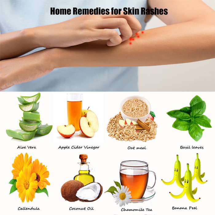 Get rid of rashes with 10 simple Skin Rash Home Remedies