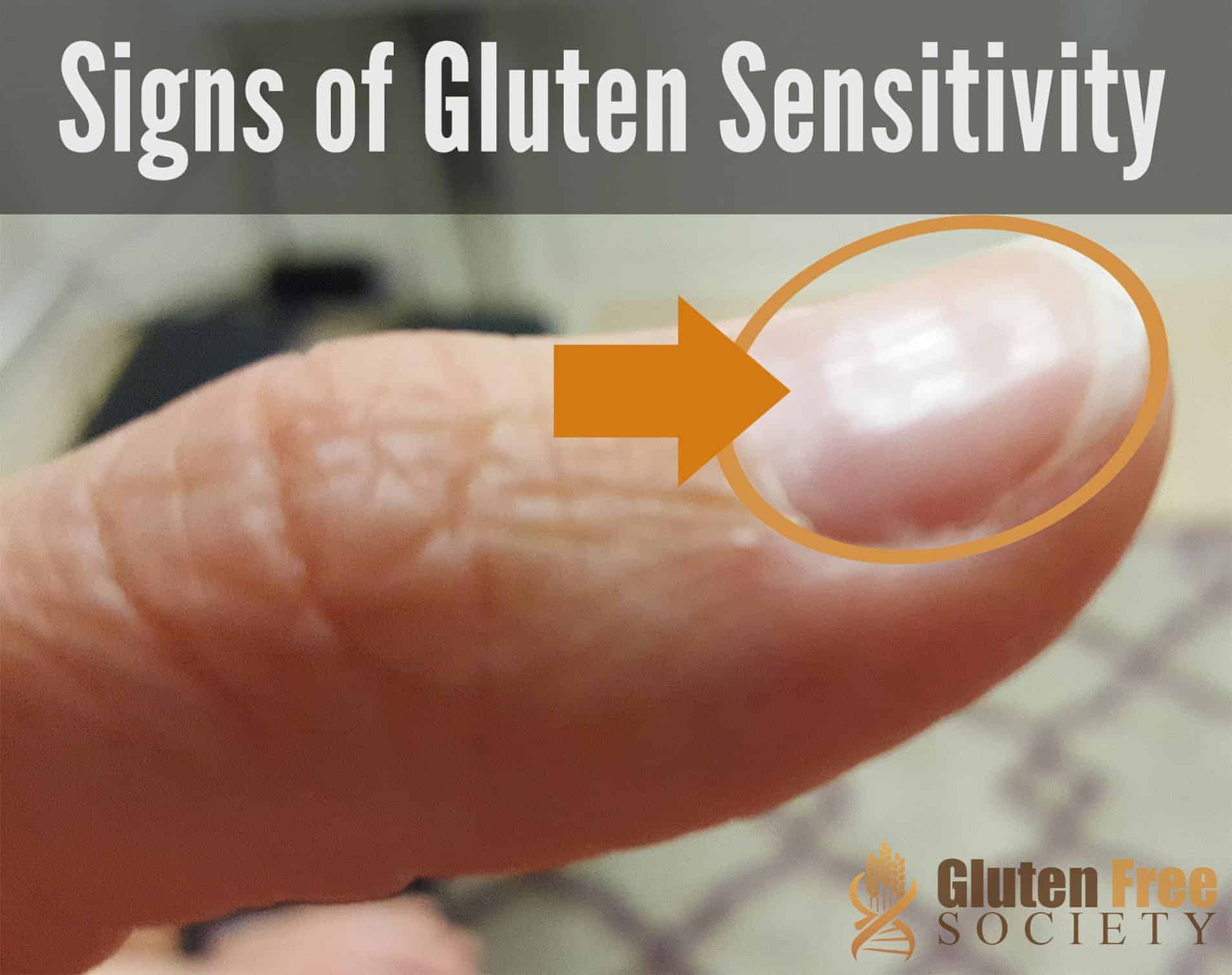 Gluten Sensitivity and Iron Deficiency Anemia