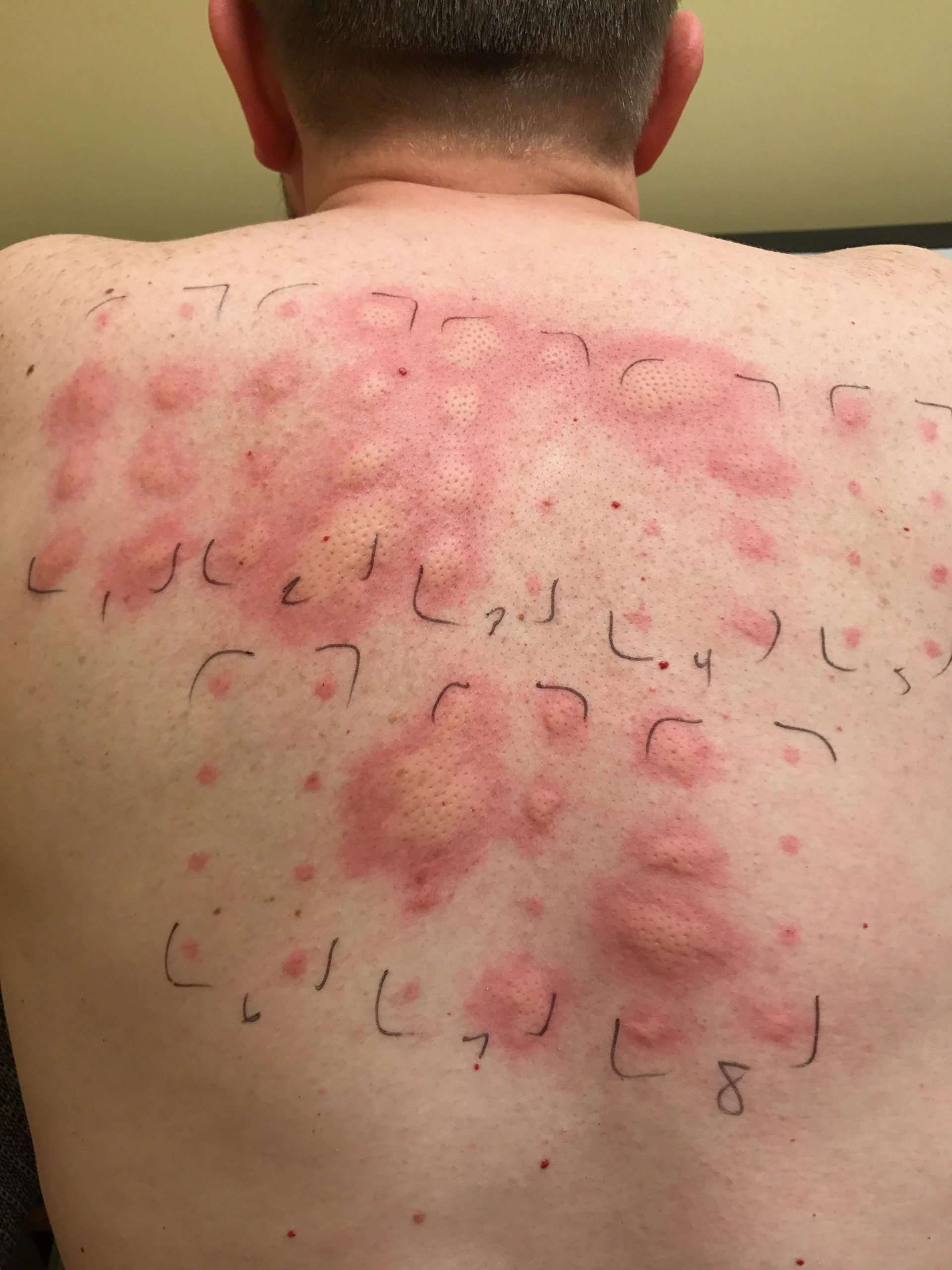 Had an allergy test done. I