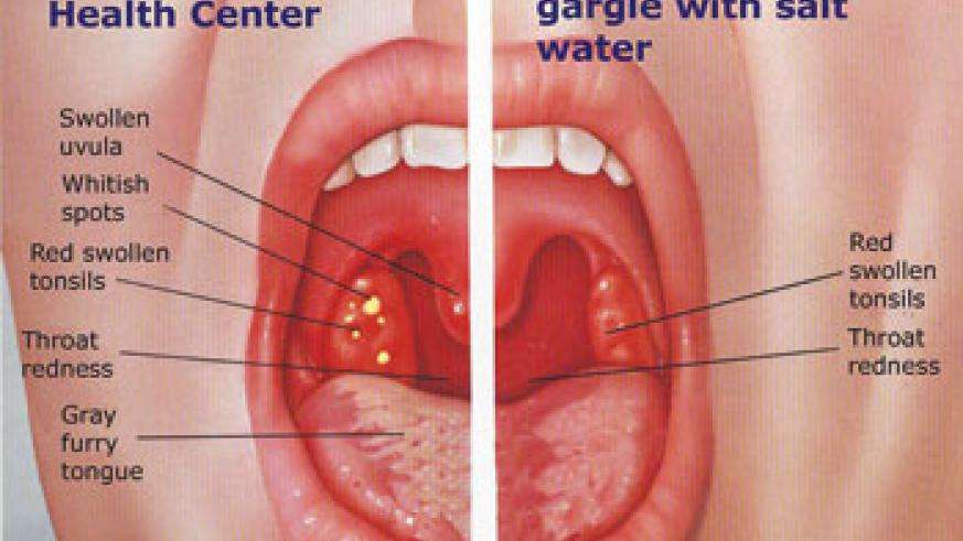 Health: Sore throat