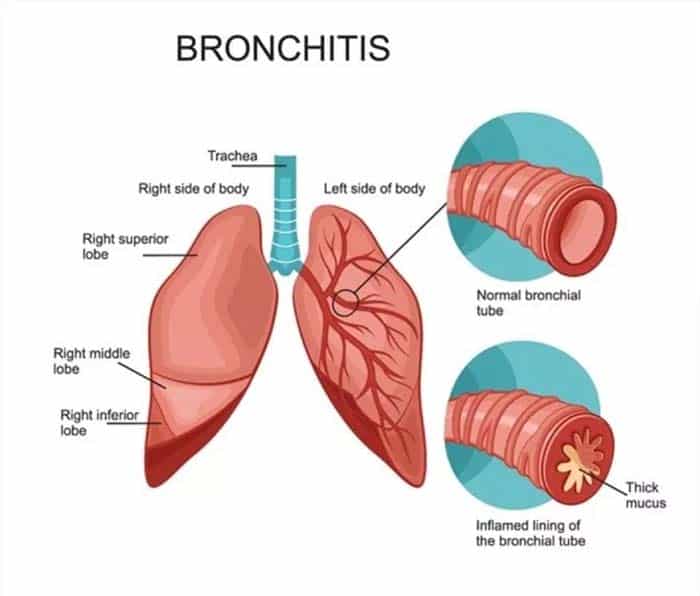 Herbal Remedy for Allergic Bronchitis