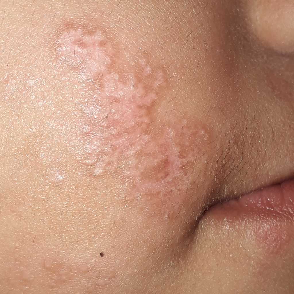 hi doctor, what is this skin allergy shown in pic below and it is ...