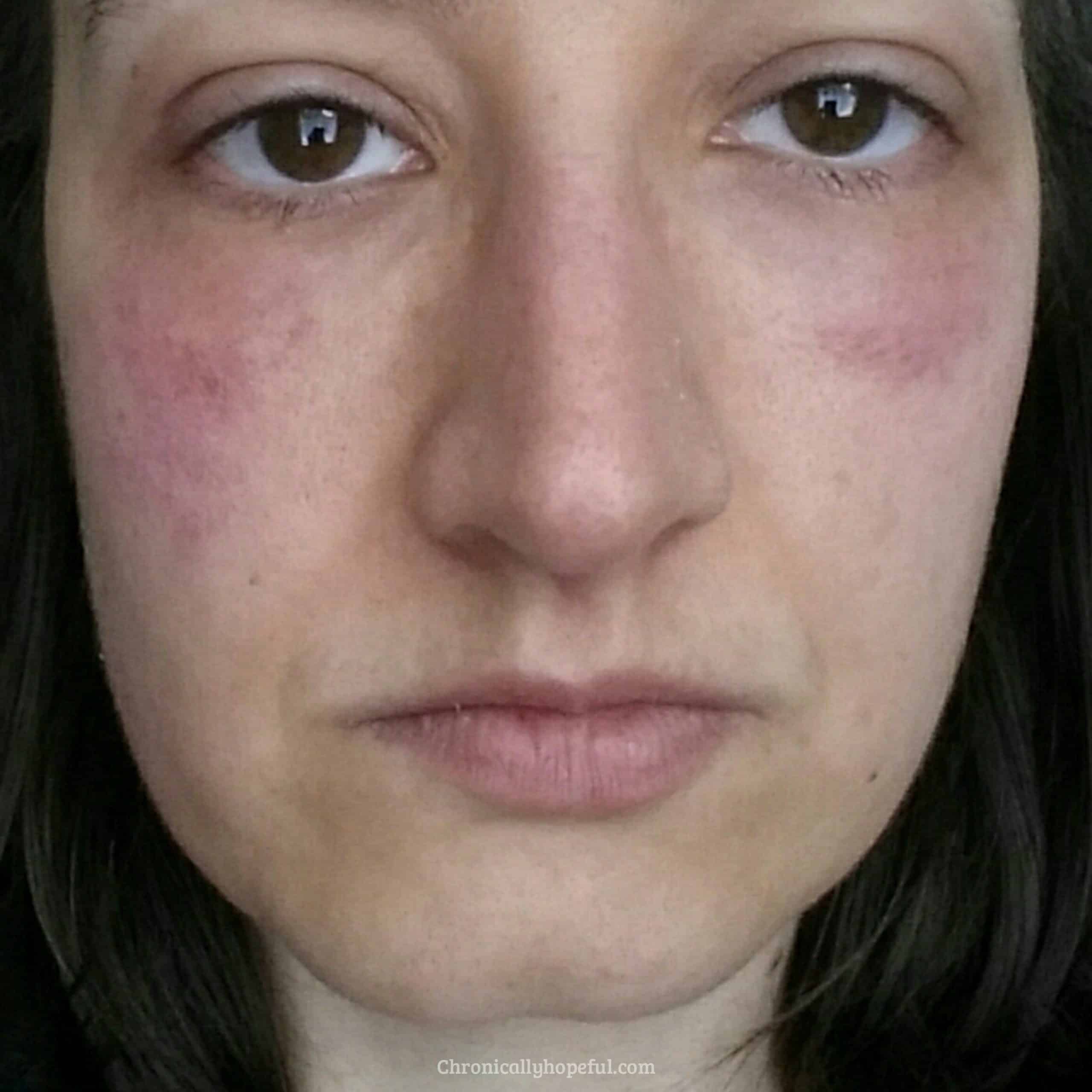 Histamine Intolerance, How Im Reducing My Rashes And Hives