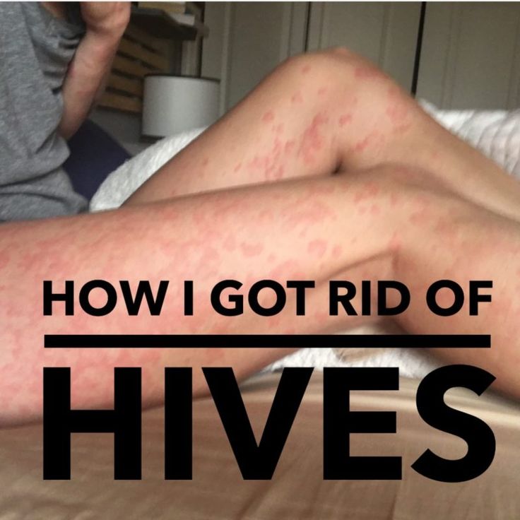 Hives and Gut Infections This past winter I was suffering from severe ...