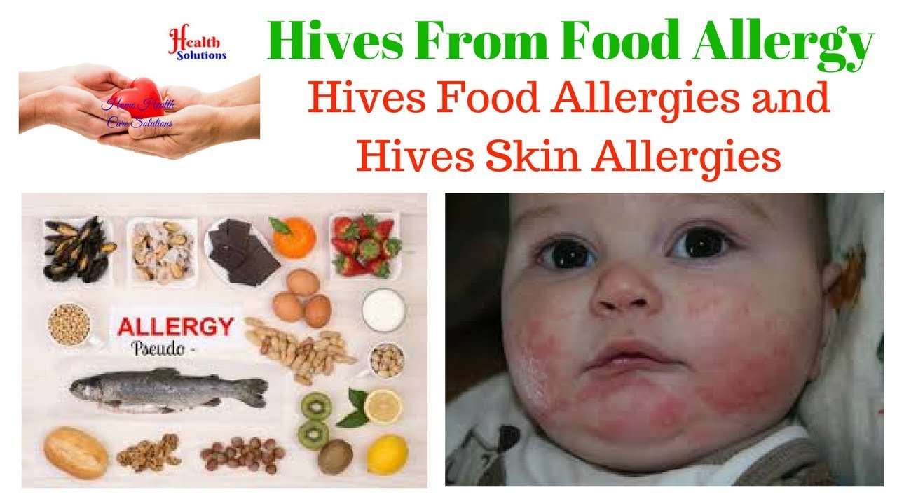 Hives From Food Allergy