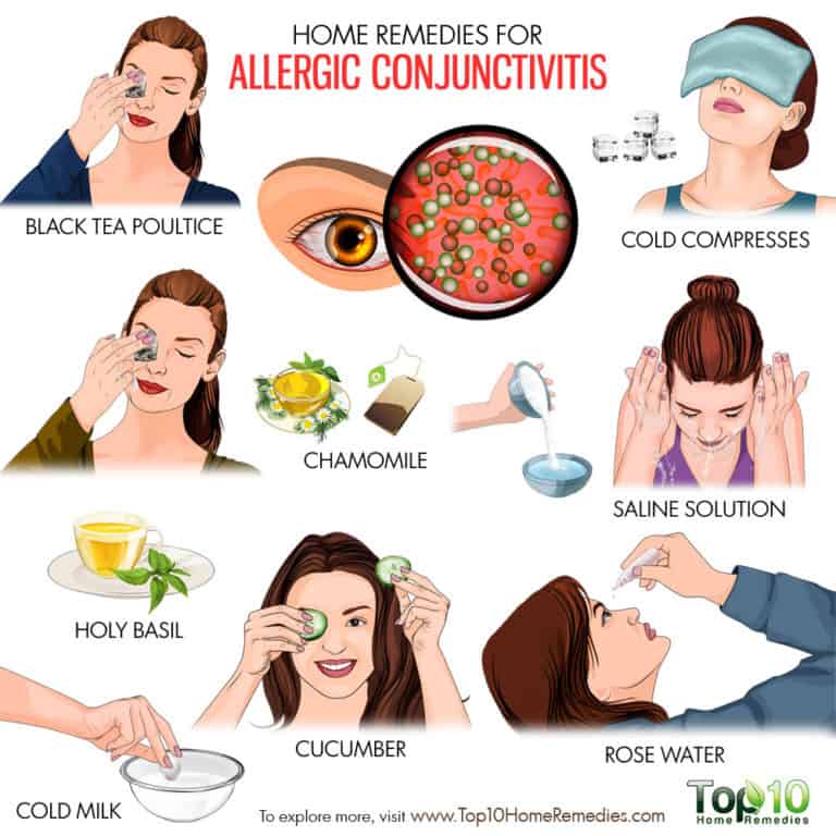 Home Remedies for Allergic Conjunctivitis