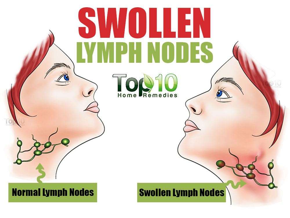 Home Remedies for Swollen Lymph Nodes