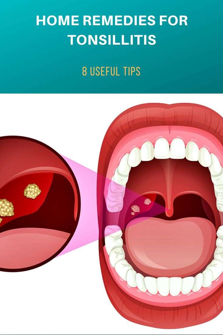 Home Remedies for Tonsillitis: 8 Useful Tips