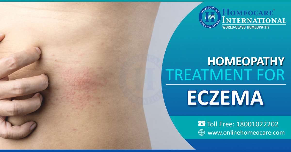 Homeopathy Treatment for Eczema